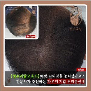 [경기 성남] 분당헤어라인_정수리_체험단 모집! (최소 40만원 이상의 혜택)